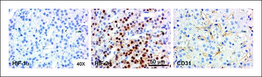 Fig. 2. Strong HIF-2α but weak HIF-1α staining in a vascularized area of a neuroblastoma specimen. Consecutive sections of a fixed and paraffin-embedded neuroblastoma specimen were stained for HIF-1α, HIF-2α, and CD31 by immunohistochemistry. Note that the HIF-2α–positive cells (brown stain) close to blood vessels (CD31-positive endothelial cells) are negative for HIF-1α.