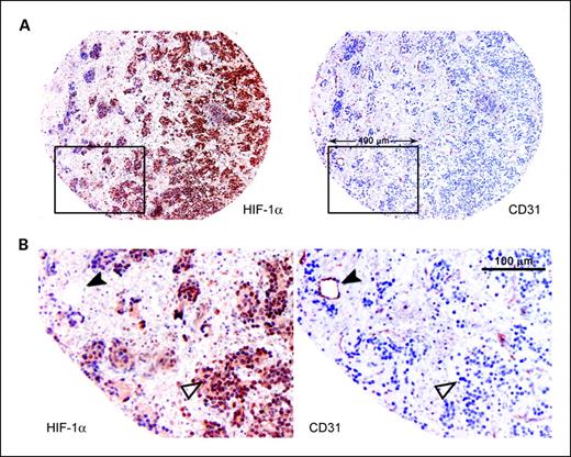 Fig. 4. HIF-1α and CD31 show inverse expression patterns. Fixed neuroblastoma specimens ordered in a tissue microarray were stained for HIF-1α and CD31 by immunohistochemistry. A, an example tissue microarray core (1-mm diameter) shows opposed expression of HIF-1α (left) and CD31 (right). B, boxed areas in A shown in higher magnification. Filled arrow, a CD31-positive vessel. Open arrow, a HIF-1α–positive area with no microvessels.