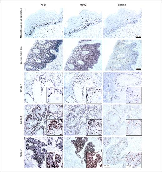 Fig. 1. Photomicrographs of paraffin wax–embedded tissue sections of representative normal squamous epithelium, carcinoma in situ, and PeScc (grades 1-3) immunohistochemically stained with antibodies to Ki67, Mcm2, and geminin. Magnification, ×200. Inset shows immunostaining at high magnification (×400).