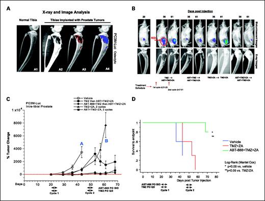 Fig. 4. Efficacy of ABT-888 in combination with TMZ in intratibial prostate PC3M-Luc xenografts. ABT-888 was administered at 25 mg/kg/d, orally, twice daily for 5 d, concurrently with TMZ at 50 mg/kg/d, orally, once daily for 5 d, for two cycles as indicated. A, X-ray images of tibia showing a normal tibia (A1), PC3M-Luc–bearing tibia with osteolytic lesion (A2), image analysis area outlined in red (A3), and quantitation area outlined in blue (A4) as a measure of tumor burden. B, representative BLI and X-ray images of mice. C, corresponding graphs for the BLI. D, Kaplan-Meier analysis based on 1,000% tumor change end point by BLI. Whereas loss of sensitivity to TMZ+ZA is observed after a second cycle, sustained efficacy is observed in the ABT-888+TMZ+ZA groups. Resistance was overcome by treatment with TMZ in the first cycle that crossed over to ABT-888+TMZ+ZA in the second cycle compared with the TMZ+ZA group treated for two cycles. Addition of ABT-888 to TMZ+ZA for two cycles resulted in a striking increase in survival compared with either the vehicle or TMZ+ZA two-cycle groups. Eighty percent of the mice in the triple-combination group did not reach end point at the end of study. Points, mean of 10 mice per treatment group; bars, SEM.