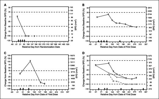 Fig. 1. Patterns of response to ipilimumab observed in advanced melanoma. Shown are the four response patterns observed in advanced melanoma patients treated with ipilimumab at 10 mg/kg in the CA184-008 and CA184-022 studies. A, response in baseline lesions; B, “stable disease” with slow, steady decline in total tumor volume; C, response after initial increase in total tumor volume; D, reduction in total tumor burden after the appearance of new lesions. SPD, sum of the product of perpendicular diameters. N, tumor burden of new lesions (C and D). D, top line, total tumor burden; middle line, tumor burden of baseline lesions; bottom line, tumor burden of new lesions. Triangles, ipilimumab dosing time points; dashed lines, thresholds for response or PD/irPD.