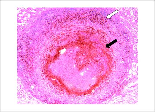 Fig. 4. Resected metastatic melanoma tumor nodule of the lung. This case is a 53-y-old male, diagnosed with melanoma of the scalp, who underwent resection and adjuvant biochemotherapy. After two cycles, imaging confirmed multiple new lung nodules consistent with recurrent disease (stage M1b). Eight months after starting ipilimumab, the dominant lung lesion was resected along with two small nodules (3 mm each). From a biopsy of one of the small nodules, note the T-cell infiltrate (white arrow) and extensive necrosis (black arrow) with no residual tumor cells. Section was stained with H&E.