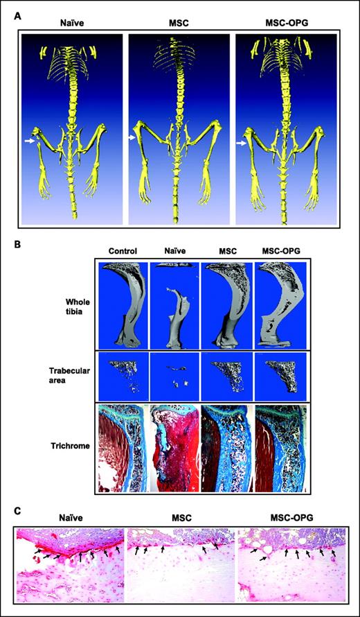 Fig. 3. Histomorphometric analysis of bone. A, three-dimensional scanning micro–computed tomography of the mouse skeleton showing restoration of tibia following mesenchymal stem cell therapy compared with untreated mice. B, three-dimensional transmission micro–computed tomography of the bone showing significant osteolysis in the tibia due to the growth of PC3 cells, whereas therapy with mesenchymal stem cells and mesenchymal stem cells overexpressing osteoprotegerin prevented osteolysis and reduced tumor burden significantly. When compared with normal tibia, both treated groups showed higher relative bone volume and trabecular bone density. Mesenchymal stem cells overexpressing osteoprotegerin–treated mice showed the highest bone volume and trabecular density. This is likely due to higher inhibition of osteoclastogenesis. Sections of tibia stained with Goldner's trichrome stain, wherein mineralized bone stains blue green, are at the bottom. Original magnification, ×25. C, reduction of osteoclast activity following treatment as determined by tartrate-resistant acid phosphatase staining. Mesenchymal stem cells and mesenchymal stem cells overexpressing osteoprotegerin showed significantly less osteoclast activity at the tumor-bone interface (arrowheads) as compared with untreated mice. Original magnification, ×200.