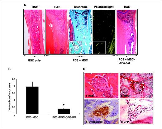 Fig. 4. Mechanism of tumor inhibition following implantation of mesenchymal stem cells in tibiae with PC3 tumors. A, histomorphology of tibia showing presence or absence of new bone formation surrounding tumor nests in mice tibiae, following implantation of unmodified mesenchymal stem cells only or following PC3 tumor cell implantation. Polarized light microscopy showing the newly formed bone, composed of randomly oriented, mineralized collagen fibers (woven bone). Original magnification, ×100. When mesenchymal stem cells were implanted into a normal tibia without the tumor cells, no such bone formation was observed (far left). When PC3 cells were injected in the tibia followed by the implantation of mesenchymal stem cells (osteoprotegerin silenced), similarly no significant bone formation (far right) was observed, suggesting the requirement of osteoprotegerin for in vivo bone formation. B, graph showing the amount of woven bone formed in the tibia after treatment with mesenchymal stem cells, osteoprotegerin–KO–mesenchymal stem cells, or mesenchymal stem cells–osteoprotegerin. Osteoprotegerin–KO–mesenchymal stem cells resulted in least amount of woven bone, indicating a requirement for simultaneous inhibition of osteoclastogenesis while mesenchymal stem cells differentiate into bone.*, P < 0.001. C, hematoxylin and eosin staining of the tibia showing spindle-like cells of mesenchymal origin bordering the tumor and the new bone (a). Significant osteoclast activity was noticed by tartrate-resistant acid phosphatase staining at the tumor-bone interface, most likely serving as the initiating factor for the mesenchymal stem cells differentiation into osteoblasts (b). Immunostaining with the human epithelial marker cytokeratin-18 indicated tumor nests surrounded by the mesenchymal stem cells (c). Staining with GFP antibody confirmed that differentiating mesenchymal stem cells are of donor origin (d). Original magnification, ×200.