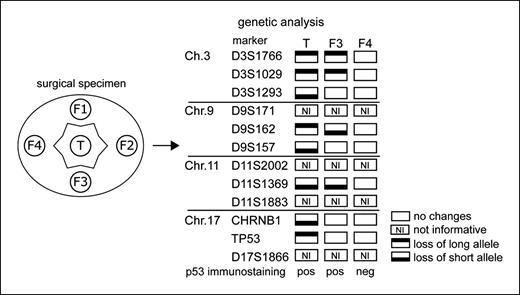 Fig. 1. Selection of normal, precancerous, and tumor tissues for proteome analysis. Microsatellite markers on chromosome arms 3p, 9p, 11q, and 17p were used to assess genetic changes in the tumor (T) and four biopsies taken from the surrounding mucosa (F1-F4). In the depicted example, F3 was considered a tumor-related precancerous field and F4 normal mucosal tissue.