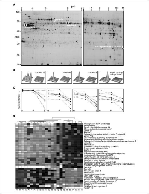 Fig. 2. Proteome analysis by 2D-DIGE. Tissue samples are indicated by type (N, normal; P, precancerous; T, tumor) and patient number (1 to 8). A, typical examples of the 2D-DIGE gel images that were obtained. B, examples of the three-dimensional spot images of the proteins with a differential level of expression that were selected for further evaluation. C, the relative expression levels of these four proteins in the individual samples. Dashed lines connect the relative protein expression of the tissue samples derived from individual patients; continuous lines connect the averaged values. D, heatmap showing hierarchical clustering of patient tissue samples based on the 40 proteins with significant differential levels of expression.