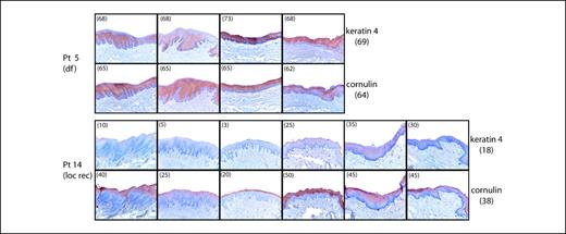 Fig. 3. Immunostaining examples of surgical margins in the prognostic validation study. Representative images of immunostained surgical margins of two patients, one who remained disease-free (df; pt 5) and one who developed a local relapse (loc rec; pt 14). Consensus score for every margin of both keratin 4 and cornulin is indicated between brackets. Staining patterns can vary slightly throughout the margin. Averaged staining percentages per patient are given between brackets at the right-hand side of the images.