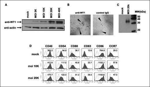Fig. 1. WT1 protein expression by Ad-tWT1–transduced human and mouse dendritic cells. A, 7-d-cultured human dendritic cells were infected with Ad-tWT1 at the indicated moi (5,000-40,000). After infection, cells were incubated for 2 d and lysed for protein extraction. Thirty micrograms of protein were applied for each lane, run on 12% Tris-HCl acrylamide gel, and transferred to polyvinylidene fluoride membranes. Membranes were incubated with anti-WT1 antibody or anti-actin antibody, followed by incubation with horseradish peroxidase–conjugated goat anti-mouse IgG antibody. An ECL kit was used for development. B, human dendritic cells, cultured on chamber slides for 7 d, were infected with Ad-tWT1 at moi 40,000 and further incubated for 2 d. Then, cells were fixed with 10% formalin and permeabilized with BD Permeabilizing Solution. Cells were stained with anti-WT1 monoclonal antibody (left) or control IgG (right), followed by biotinylated anti-mouse IgG antibody. Color was developed with a Vectastain kit and 3,3′-diaminobenzidine. Arrowheads, colonies of dendritic cells. C, 7-d-cultured mouse dendritic cells were infected with Ad-tWT1 at moi 20,000, incubated for 2 d and lysed for protein extraction. Immunoblotting with anti-WT1 monoclonal antibody was done as described in A. D, human dendritic cells were infected with Ad-tWT1 at the indicated moi. After infection, cells were incubated for 2 d and stained with the indicated antibodies for analysis by flow cytometry. The mean fluorescence intensity of expression of each surface protein is indicated within each histogram.