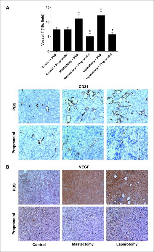Fig. 4. The effect of propranolol on angiogenesis in surgically stressed mice. SKOV3ip1 tumor samples obtained from control or surgically stressed mice were treated with placebo (PBS) or propranolol pump and stained for CD31 (A) and VEGF (B) by immunohistochemistry. All photographs were taken at original magnification ×100. Bars, SE. *, P < 0.05.