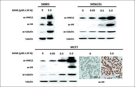 Fig. 1. Inhibition of intracellular histone H4 and α-tubulin de-acetylation by SAHA. Human breast cancer cell lines SKBR3, MDA231, and MCF7 were treated for 24 h with indicated doses of the pan-HDAC inhibitor, SAHA. Cell lysates and cell button sections were probed for total and K12 specific H4 acetylation as well as acetylated α-tubulin as described in Materials and Methods. Dose-dependent increases in ac-H4, ac-H4K12, and ac-tubulin as detected by Western blotting are shown in the three cell lines. Increased expression of ac-H4 in MCF7 (after SAHA treatment) is shown by immunohistochemistry (original magnification, ×200).