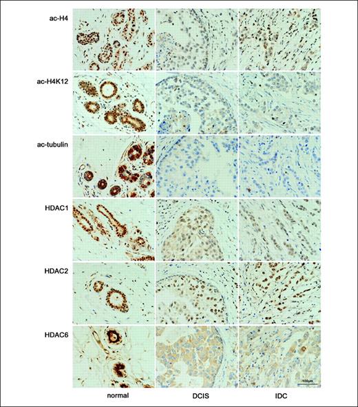 Fig. 2. Acetylation and HDAC expression in normal breast epithelium, DCIS, and IDC. The three different histologic components with the six antibodies are shown for one representative case (#38). Ac-H4, ac-H4K12, HDAC1, and HDAC2 show nuclear staining, whereas ac-tubulin and HDAC6 show cytoplasmic staining with substantial heterogeneity in background staining (original magnification, ×400).