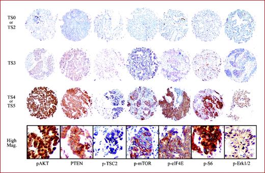 Fig. 1. Representative examples of immunohistochemical staining by p-AKT, PTEN, p-TSC2, p-mTOR, p-eIF4E, p-S6, and p-Erk1/2 (from left column) of NSCLC specimens. The TMA cores of the first line show TS0 or TS2, those of the second line show TS3, and the third line shows TS4 or TS5 for each antibody. Diameter of tissue core, 0.6 mm. Photomicrographs of the bottom line show high magnification view of the third line TMA cores each. Original magnification, ×400.