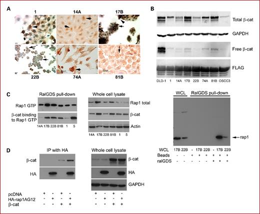 Fig. 1. Cytoplasmic and nuclear pools of free β-catenin are detectable in human SCC. A, UM-SCC-1, UM-SCC-14A, UM-SCC-17B, UM-SCC-22B, UM-SCC-74A, and UM-SCC-81B cells grown on Lab-Tek slides were incubated with β-catenin monoclonal antibody (1:3,000) followed by secondary antibody, 3,3′-diaminobenzidine detection, and counterstaining with hematoxylin. IgG control was negative (data not shown). Cytosolic and nuclear staining (1 and 74A, arrows), cytosolic, membrane, and nuclear staining (17B and 81B, arrows), and membrane staining (22B, arrows) were observed. Scale bars, 60 μm (14A, 74A, and 81B), 40 μm (17B and 22B), and 20 μm (1). B, whole-cell lysates prepared from DLD-1, UM-SCC-1, UM-SCC-14A, UM-SCC-17B, UM-SCC-22B, UM-SCC-74A, UM-SCC-81B, and OSCC3 were immunoblotted with anti–β-catenin (top) and GAPDH (top middle) as a loading control. Free β-catenin was retrieved with the FLAG-tagged cytoplasmic tail of E-cadherin and immunoblotted with anti–β-catenin (bottom middle) and anti-Flag (bottom) as a loading control. C, β-catenin binds to Rap1GTP. Top left, cell lysates of human SCC cell lines UM-SCC-14A, UM-SCC-17B, UM-SCC-22B, UM-SCC-81B, UM-SCC-1, and UM-SCC-5 were evaluated for active Rap1 by the ralGDS pull-down assay; bottom left, the same filter was blotted with anti–β-catenin; middle, whole-cell lysates were blotted to show total Rap1, β-catenin, and actin; right, control for ralGDS pull-down assay. Right, lanes 3 to 8, for the ralGDS pull-down assay, beads were incubated alone or with whole-cell lysates of 17B and 22B in the presence or absence of ralGDS as indicated; lanes 1 and 2, total Rap1 in whole-cell lysates from 17B and 22B was also immunoblotted. D, HEK293 cells were cotransfected with HA-tagged Rap1AG12 or pcDNA control vector and β-catenin as indicated. HA-Rap1G12 was immunoprecipitated and the immunoprecipitates were blotted with anti–β-catenin (top left) and anti-HA (bottom left) antibodies. Whole-cell lysates were immunoblotted to show total β-catenin (top right), HA (middle right), and GAPDH (bottom right).