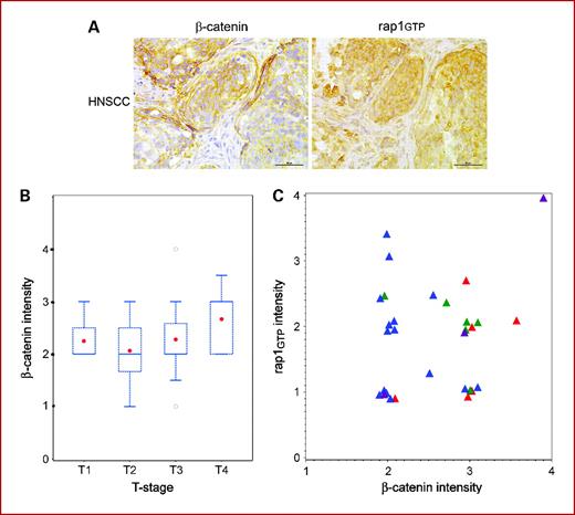 Fig. 5. The prognostic effect of active Rap1 on tumor N stage depends on the expression of cytosolic β-catenin. A, a 5-μm tissue section of a human HNSCC tissue microarray was incubated with β-catenin antibody (left) or IgG control (data not shown) or Rap1 antibody (right) as described in Materials and Methods. After 3,3′-diaminobenzidine reaction, the slides were counterstained with hematoxylin. Scale bars, 50 μm. High cytosolic β-catenin and Rap1GTP stainings are shown for the same tumor specimen. B, high β-catenin intensity is associated with more advanced T stage as assessed by the Spearman correlation coefficient and represented in box and whisker plots. Patient groups: T1, tumor size <2 cm (n = 4); T2, tumor size 2 to 4 cm (n = 10); T3, tumor size >4 cm (n = 16); T4, tumor invades through cortical bone, inferior alveolar nerve, floor of mouth, or skin of face (n = 13). C, the proportional odds model was used to assess the association between N stage and the interaction of Rap1 and β-catenin. When cytosolic β-catenin was high, higher active Rap1 intensity was prognostic of more advanced N stage; when β-catenin intensity is low, lower active Rap1 is associated with more advanced N stage. Early N stage is N0 (red triangles; n = 6) and N1 (green triangles; n = 6); advanced N stage is N2 (blue triangles; n = 15) and N3 (purple triangles; n = 3).