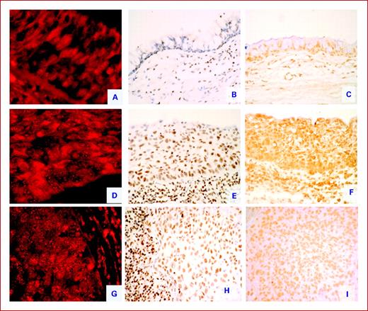 Fig. 1. RTL assessed by Tel FISH in normal bronchial epithelium (A), in severe dysplasia (D), and in invasive SCC (G). TRF1 and TRF2 immunohistochemical expressions in corresponding normal bronchial epithelium (B and C, respectively), in severe dysplasia (E and F, respectively), and in invasive SCC (H and I, respectively).