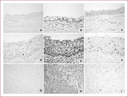 Fig. 2. Immunohistochemical expression of p-ATM, p-CHK2 and p-ATM in the same cases of normal bronchial epithelium (A-C), severe dysplasia (D-F), and SCC (G-I).