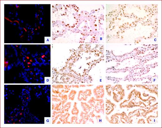 Fig. 3. Relative telomere length (RTL) assessed by Tel FISH in Atypical Adenomatous Hyperplasia AAH (A), in Adenocarcinoma In Situ AIS (D), and in invasive papillary adenocarcinoma ADC (G). TRF1 and TRF2 immunohistochemical expressions in corresponding AAH (B and C, respectively), in AIS (E and F, respectively), and in ADC (H and J, respectively).