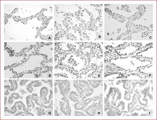 Fig. 4. Immunohistochemical expression of p-ATM, p-CHK2 and p-ATM in the same cases of AAH (A,B,C), AIS (D,E,F) and ADC (G,H,J).
