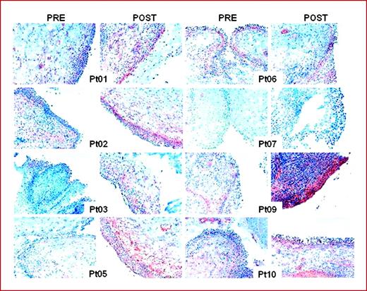 Fig. 2. CD40L protein was detected in biopsies pretreatment and posttreatment cycles by immunohistochemistry. Original magnification, ×50. Pt, patient.