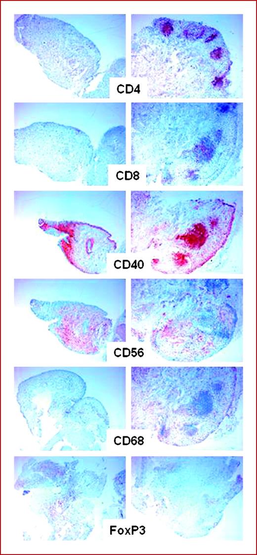 Fig. 4. Histochemical evaluation of infiltrating immune cell populations (CD4+ T cells, CD8+ T cells, CD56+ NK cells, CD68+ myeloid cells, FoxP3+ T regulatory cells) exemplified in patient 01. CD40 stained immune cells and urothelial cells.