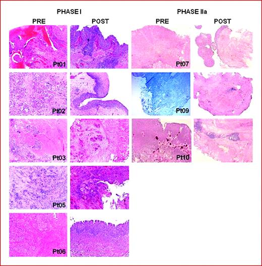 Fig. 6. Hematoxylin-eosin-stained sections showing the histopathologic findings before and after AdCD40L therapy. Phase I shows high-grade tumors pretherapy. Patient 01 had few remaining malignant cells, whereas patients 02, 05, and 06 did not have high-grade tumors in the bladder posttreatment. However, patient 02 had remaining tumor in the ureter and metaplasia in the urothelial lining. Patients in phase IIa had all remaining superficial tumors, but patient 10 had reduction in tumor size. Patient 09 presample is a frozen section stained with hematoxylin. All postbiopsies showed increased inflammation except patient 03.