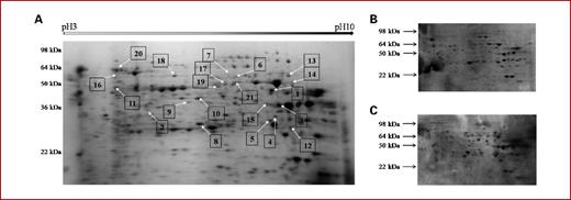 Fig. 1. Representative two-dimensional protein gel of HCC827 cellular lysates with accompanying immunoblots. Coomassie-stained two-dimensional gel for proteins isolated from HCC827 cellular lysates (A), with matched immunoblots from the control (B) and stage I adenocarcinoma (C) cohorts.
