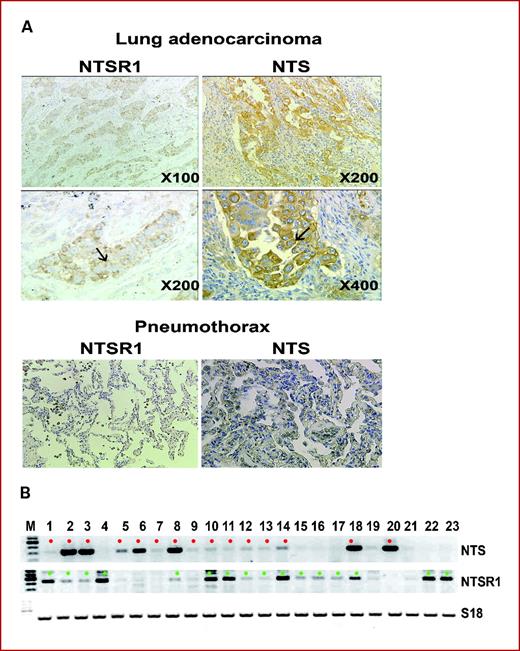 Fig. 2. Neurotensin (NTS) and NTSR1 expression in patients with primary lung adenocarcinomas. A, example of immunohistochemistry for NTSR1 (left) and NTS (right). Top, positive labeling of patients with primary lung adenocarcinomas; bottom, negative labeling of idiopathic pneumothorax at ×200 magnification. B, NTS and NTSR1 transcript analysis on RNA from 23 patients with primary lung adenocarcinomas stage I. M, 100 bp ladder. Patients with red dot or green dot were considered as positive for NTS or NTSR1, respectively.