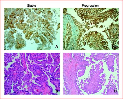 Fig. 2. Immunohistochemical staining (A) for VEGF-A (score in the tumor epithelium, 70) and H&E staining (B) in a patient with SD following study treatment. VEGF-A staining (score in the tumor epithelium, 140; C) and H&E staining (D) in a patient with disease progression following study treatment. Magnification, ×10.