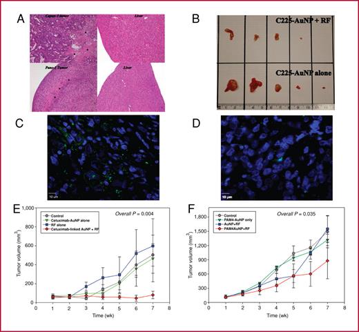Fig. 6. Panc-1 and Capan-1 tumors showed significant increases in necrosis (*) after treatment with antibody-conjugated AuNPs and RF field exposure whereas liver tissue remained normal (A). Panc-1 tumors after 6 weeks of combined C225-AuNP treatment and RF exposure (B, top row) are significantly smaller than tumors in mice that just received C225-AuNPs treatment (P = 0.0097; B, bottom row). There was 1 complete response and 1 near-complete response in the dual-treatment group. Cleaved caspase-3 was increased in tumors from mice that had undergone antibody-targeted AuNP treatment and RF field exposure (C; Panc-1 xenograft with DAPI in blue and cleaved caspase-3 labeled in green) compared with tumors from control mice (D; represented by the Panc-1 xenografts from untreated controls). RF exposure after antibody-AuNP treatment resulted in significant decreased tumor volumes (E,F).