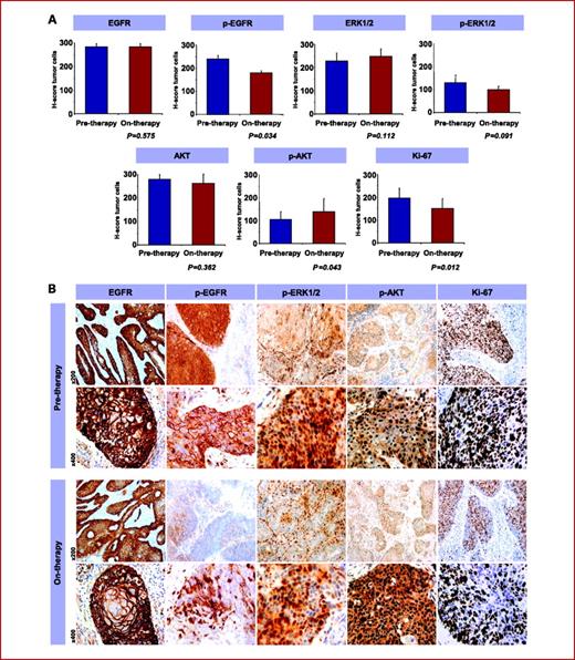 Fig. 3. Pharmacodynamic effects of nimotuzumab in SCCHN. A, bar graphs summarizing the changes on paired tumor biopsies (mean and SD). Significant downregulation in p-EGFR expression (P = 0.034) and proliferation (P = 0.012) were observed in tumor cells after nimotuzumab treatment. In addition, a significant upregulation of p-AKT expression (P = 0.043) and a nonsignificant trend toward a reduction in p-ERK1/2 (P = 0.091) were observed. No significant changes were detected for total EGFR, ERK1/2, or AKT. B, representative pictures for the expression of EGFR, p-EGFR, p-ERK1/2, p-AKT, and proliferation in pre- and on-therapy tumors, at two magnifications (×200 and ×400). Total EGFR was diffusely detected in the membrane of tumor cells, showing similar expression levels in pre- and on-therapy time points. Phosphorylated/activated EGFR was detected in most of tumor cells in pretherapy biopsies and nimotuzumab treatment significantly reduced the intensity and percentage of stained cells. Nuclear p-ERK1/2 was highly expressed in tumor cells and some stromal cells. Nimotuzumab reduced the proportion of tumor cells with nuclear p-ERK1/2 staining. p-AKT was observed in the cytoplasm and nucleus of tumor cells. Upregulation of p-AKT was observed following nimotuzumab exposure. Proliferation (Ki67) was reduced by nimotuzumab.