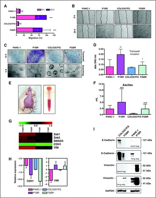 Figure 4. Anti-VEGF treatment–resistant pancreatic cancer cells showing features of malignant progression and EMT. A, levels of cancer cell migration between anti-VEGF treatment–resistant and treatment-sensitive pancreatic cancer cells. Results are presented as percentages of the total distances between the wound edges enclosed by cancer cells. The mean values and 95% CIs from 3 independent experiments done in quadruplicate are shown. ***, P < 0.001 (unpaired Student's t test). B, photographs of the wound area were taken by using phase-contrast microscopy immediately and 24 hours after the incision. C, cell invasion assays. Representative photographs of Matrigel-coated transwell traversing activity and branching morphogenesis in 3D Matrigel of pancreatic cancer cells; D, to quantify invasiveness, the stained invading cells were lysed and their absorbance measured. The mean values and 95% CIs are shown. **, P < 0.01; *, P < 0.05 (unpaired Student t-test). E, representative photograph of hemorrhagic ascites in an orthotopic treatment-resistant P1BR tumor-bearing mouse. F, amount of ascites drained from pancreatic tumor–bearing mice. The mean values and 95% CIs are shown. ***, P < 0.001 (unpaired Student t-test). G, heat map showing EMT gene expression values in treatment-resistant FGBR versus treatment-sensitive COLO357FG and treatment-resistant P1BR versus treatment-sensitive PANC-1 cells. H, results of quantitative real-time PCR (RT-PCR) analysis of E-cadherin (CDH1) and vimentin (VIM) genes presented as the fold change in RNA expression between the gene of interest and β-actin. The mean values and 95% CIs from 3 independent experiments conducted in quadruplicate are shown. ***, P < 0.001 (unpaired Student's t test). I, expression of E-cadherin and vimentin proteins. GAPDH, glyceraldehyde-3-phosphate dehydrogenase.