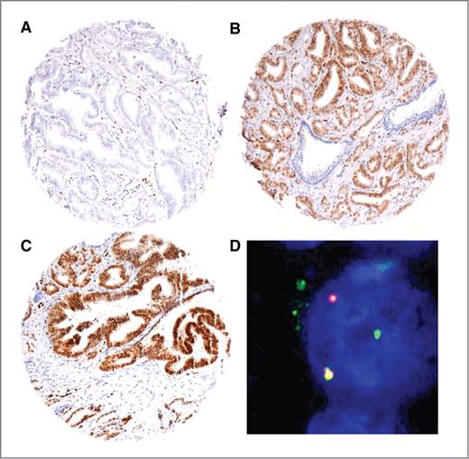 Figure 1. Representative images of ERG IHC and ERG gene rearrangement detected by FISH. A, negative staining in prostate cancer, positive staining in adjacent blood vessels. B, positive staining in prostate cancer, negative staining in nonneoplastic prostate epithelium. C, positive staining in prostate cancer and adjacent high-grade PIN. D, FISH image showing an ERG rearrangement.