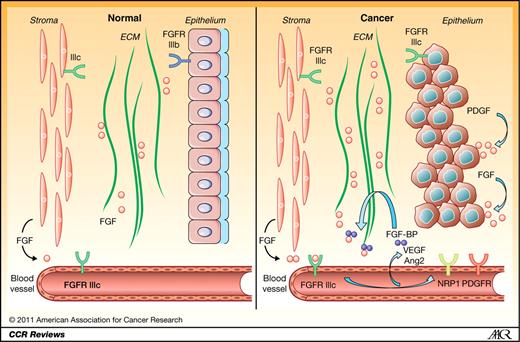 Figure 1. Changes in FGF and FGFR in the microenvironment and epithelium in normal tissue and cancer. Compared with normal tissue, alternative splicing of the FGFR gene can switch expression of FGFR from the IIIb isoform to the ligand promiscuous IIIc isoforms. Furthermore, release of FGF from the tumor and stroma may initiate tumor angiogenesis. FGF-BP–mediated reduction of the affinity of FGF-2 to heparin can induce its release from the ECM. FGF-BP, FGF binding protein; PDGF, platelet-derived growth factor; PDGFR, platelet-derived growth factor receptor.