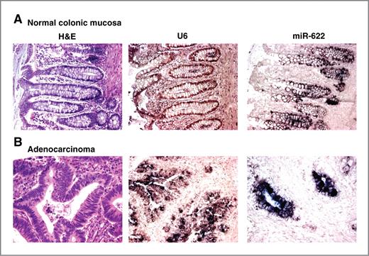 Figure 3. In situ hybridization (ISH) of miR-622 in normal colorectal mucosa and CRC tissues. miR-622, positive control (U6) and negative control (no probe) ISH analyses were conducted in normal colorectal mucosa (A) and a group of CRC samples (B). Staining for miR-622 was observed in the epithelium throughout the colonic crypt, but there was no staining in the stromal cells. There was a marked overexpression of miR-622 in the CRC samples compared with the normal colorectal mucosa. H&E, hematoxylin–eosin.