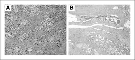Figure 1. Gleason score 3 + 4 = 7 carcinoma, where the pattern 4 is composed of poorly formed glands (A). Focal extraprostatic extension with tumor glands adjacent to periprostatic adipose tissue (B).