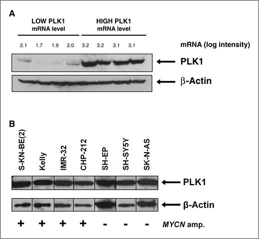 Figure 2. PLK1 protein levels (Western blot analysis) and PLK1 transcript levels (given as log intensities as determined by microarray analysis) in 8 primary A, neuroblastoma samples and B, 7 neuroblastoma cell lines.