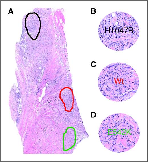 Figure 1. Primary breast cancer, different invasive areas were laser captured and subsequent mutation analysis showed heterogeneity. A, full section. B, area with exon 20 mutation (H1047R). C, area with wild type (Wt). D, area with exon 9 mutation (E542K). Overall, the status was a double mutation exon 9/exon 20 from the core analysis.