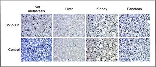 Figure 3. Immunohistochemical staining for viral particles in tumor and noninvolved tissues. Tissue sections from a patient with extensively pretreated advanced small cell carcinoma, who died of progressive disease on day 28 after SVV-001 administration (107 vp/kg) were subject to immunohistochemical staining using mouse SVV-001 antiserum as primary antibody or nonimmune mouse serum as control. Extensive intracellular viral replication is demonstrated in tumor tissue, but no nonmalignant tissue sections (400×).