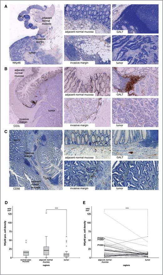 Figure 1. Immunohistochemistry for NKp46+-, CD3ϵ+-, and CD56+-cell distributions. A, Immunohistochemical staining for NKp46 and representative magnification from different regions. Overview magnification ×1.5, higher magnifications ×12. Counterstained with haematoxylin. B, Immunohistochemical staining for CD3ϵ and representative magnification from different regions. C, Immunohistochemical staining for CD56 and representative magnification from different regions. (D) Distribution of NKp46+-cell densities [cells/mm2] in different regions (adjacent normal mucosa versus tumor, Mann–Whitney U-test, ***P < 0.001). (E) Paired depiction of corresponding cell densities in the tumor and in adjacent normal mucosa (P1040, P1080, P1085 labels indicate individual patients from which frozen material was available for protein quantification, Wilcoxon signed rank test, ***P < 0.001).
