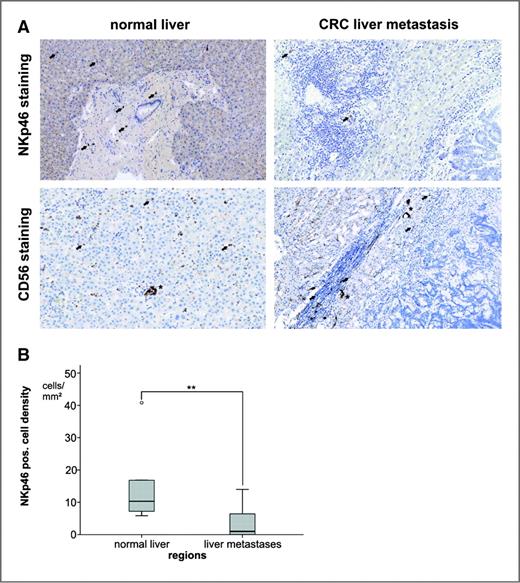 Figure 2. NKp46+ NK-cell distribution in liver and CRC liver metastases. (A) Microscopical analyses of normal liver and CRC liver metastases, comparing NKp46 staining and CD56 staining arrows indicate positive lymphocytes, asterisks mark CD56+ small bile ducts). (B) Distribution of NKp46+ NK-cell densities in normal liver and in colorectal cancer liver metastases (Mann–Whitney U-test, **P < 0.01).