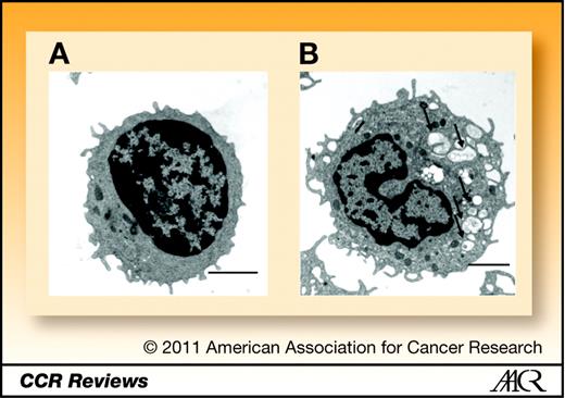 Figure 5. Pharmacodynamic assay for autophagy inhibition. Electron micrographs of peripheral blood mononuclear cells from a glioma patient enrolled on the phase I trial of temozolomide, radiation, and HCQ. A, pretreatment and B, 3 weeks of combined therapy. Arrows, AVs; scale bar 200 μm.