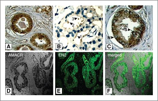 Engrailed-2 (EN2): A Tumor Specific Urinary Biomarker for the Early ...