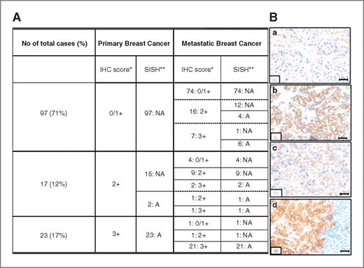Figure 1. HER2 status in 137 primary and paired metastatic breast cancer Table A: comparison of HER2 status in 137 primary and paired metastatic breast cancer as determined by immunohistochemistry and SISH. Table B: Two representative examples of HER2 immunohistochemical variation between primary and metastatic breast cancer: (a) a primary breast cancer with HER2 score 0 which becomes (b) score 3+ in the metachronous liver metastasis; (c) a primary breast cancer with HER2 score 2+ which becomes (d) score 3+ in the metachronous supraclavear metastatic lymphnode. Scale bar = 30 μm. IHC, immunohistochemistry; NA, nonamplified; A, amplified; *, P < 0.0001; **, P = 0.01.