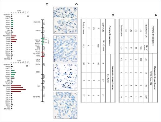 Figure 3. HER2 gene and chromosome 17 gain in the 123 primary and metastatic breast carcinomas with unchanged HER2 status. Table A: The 100 nonamplified PBC maintained the same HER2 gene CN in their paired metastases whereas 13 of 23 (57%) cases, amplified both in primary and in metastatic BC, showed an increased HER2 gene CN in MBC as compared to PBC. Table B: An increased CEP17CN was observed in MBC as compared to their paired PBC. The k-test indicated good concordance between HER2 gene CN and CEP17CN gain during BC progression (k = 0.54, P < 0.0001). C, An illustrative SISH case showing: (a) a HER2 low amplification (gene CN >6) associated (b) to Chr17 disomy (CEP17 = 2) in the primary breast cancer and (c) a HER2 high amplification (gene CN >20) associated (d) to high polisomy (>4 CEP17 copy number) in the autologous supraclavear metastatic lymphnode. Scale bar = 10 μm. D, Schematic diagram of chromosome 17. The positions of HER2/NEUROD2 (17q12), WSB1 and NOS2A (17q11) are shown as red and green lines, respectively. The illustrative SISH case (C) was also analyzed by MLPA showing: (a) a low level of HER2 and WSB1 amplification in PBC as compared (b) to paired metastasis (HER2 ratio 3.72 vs. 10.2; WSB1 ratio 1.45 vs. 3.13).