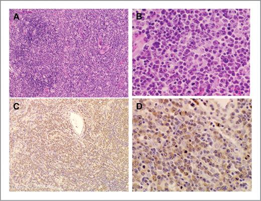 Figure 1. Hematoxylin and eosin staining (A and B) and immunohistochemical staining for nm23 (C, D) of PTCL-NOS. The nodal structure is largely obliterated by a diffuse process with occasional remaining atrophic lymph follicles on the left (A). The proliferating cells are medium-sized to large and have a considerable amount of cytoplasm (B). They are diffusely positive for nm23 (C), and cytoplasmic staining is evident at this higher magnification (D). A and B, H&E stain; C and D, immunoperoxidase stain with hematoxylin counterstain. A and C, ×10; B and D, ×40.