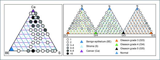Figure 1. Ternary graphs illustrating the cellular composition of the samples. The ternary graph to the left shows the distribution of the samples (n = 133) with respect to the volume percentage of benign epithelium (BE), stroma (S), and cancer (Ca) content. The colored triangles represent 100% of the specific tissue type, and the gray shade of the circles indicates the number of samples sharing the same tissue composition. Each colored line represents 10% of the specific tissue type so that samples with equal parts of BE, S, and Ca will be placed in the center of the triangle. The 3 graphs to the right show in an analogous manner the distribution of the cancer-containing samples with respect to the volume percentage of different Gleason grades. In these graphs, benign epithelium and stroma are combined in the common category N (normal).