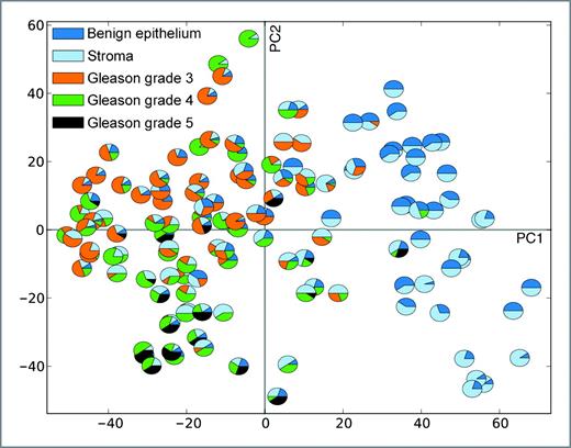 Figure 2. Score plot illustrating the relationship between the prostate samples. The PLS multivariate regression model is based on gene expression data (expression values for each gene as independent variables) and MR data (spectral value for Citrate, Creatine, Cho, PC, and GPC as dependent variables). Each sample in the study is represented by 1 pie chart, showing the relative amount of the respective tissue type (stroma, benign epithelium and in samples containing cancer, the respective Gleason grades were evaluated). The figure illustrates the variance of the samples and the direction which maximizes the variance is called the principal components. The first principal component (PC1) is the direction in the data set which maximizes the variance. This component separates benign from malignant samples. The amount of stroma in the benign samples widens the variation of these samples. The second principal component (PC2) is the direction which maximizes variance among all directions orthogonal to PC1. PC2 indicates a clustering of malignant samples depending on cancer aggressiveness. The low aggressive cancer samples (Gleason score 3 + 3) cluster mostly in the top left quadrant and highly aggressive samples (Gleason score ≥ 8) cluster with some exceptions in the bottom left quadrant of the figure. The intermediate aggressive samples (Gleason grade 3 + 4 and 4 + 3) are not clearly clustered, but there is a trend to more Gleason grade 4 + 3 samples clustering toward the highly aggressive samples.