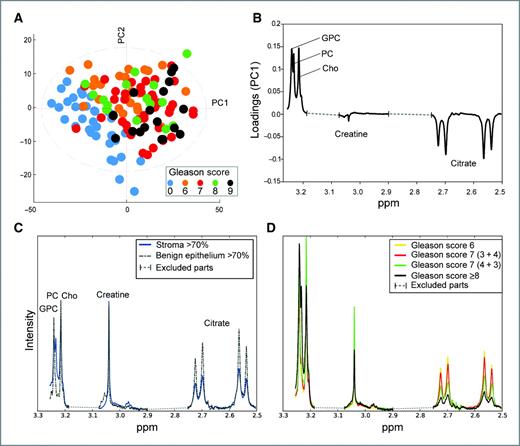 Figure 3. HR-MAS MRS spectra from benign and malignant prostate samples. HR-MAS spectra (region 3.25–2.5ppm, n = 133) correlated to Gleason score where (A) the PLS score plot of PC1 and PC2 (describing 72.4% of total variation) shows a discrimination of benign samples (blue, n = 35) from cancer samples (orange, red, green, black; n = 98) and the model shows a strong correlation to Gleason score (R2 = 0.52). B, the loading weights on PC1 (explaining 60.3% of the total variation) show an increased level of ChoCC and a decreased level of citrate in cancer samples compared with benign samples and likewise in samples with higher Gleason scores compared with lower Gleason scores. C and D, share the same y-axis showing mean spectra of benign samples in (C) with less citrate in samples with high stromal content (>70%) compared with samples with mostly benign epithelium (>70%). D, mean spectra of cancerous samples with equal amount of stromal and benign epithelium indicate reduced citrate levels with increasing aggressiveness. The dashed lines in the spectra are areas not included in the statistical model and are therefore excluded.