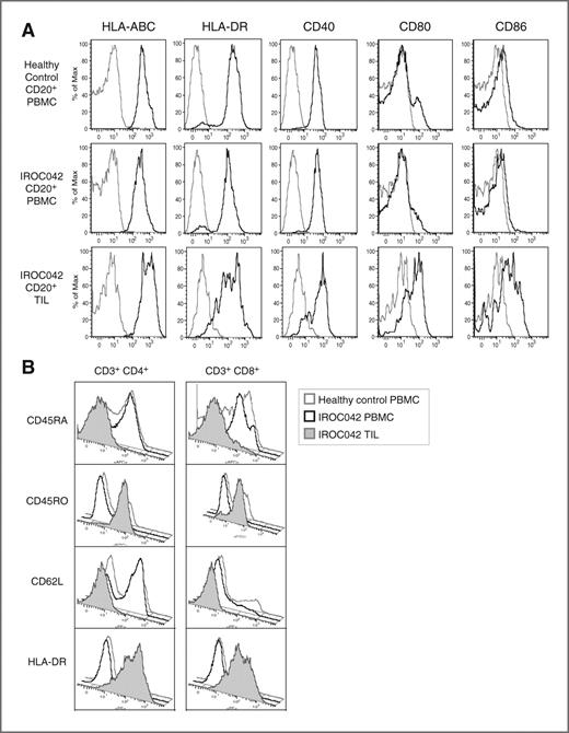 CD20+ Tumor-Infiltrating Lymphocytes Have an Atypical CD27− Memory ...