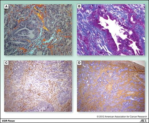 Figure 1. PDA contains an abundant stroma. A, mouse PDA tissue was stained with picrosirius red and imaged under polarized light to visualize collagen fibers (×20 magnification). B, Masson trichrome staining highlights connective tissue distribution in an example of mouse PDA. Collagen fibers are staining in blue with the cytoplasm appearing in red (×40 magnification). C, immunohistochemistry for SPARC on murine PDA (α-SPARC polyclonal antibody, protein tech catalog number: 15274-1-AP, ×10 magnification). D, histochemical staining of hyaluronan (biotinylated hyaluronan binding protein, Calbiochem 385911, ×10 magnification) reveals pan-stromal deposition in murine PDA.